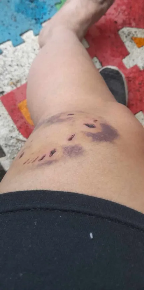 Vecina del barrio El Mallín denuncia ataque de perros: “Espero que no le pase a nadie más”